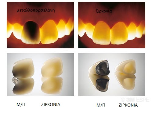 123Lava Zirkonoxid Metallkeramik 123Lava Zirkonoxid Metallkeramik