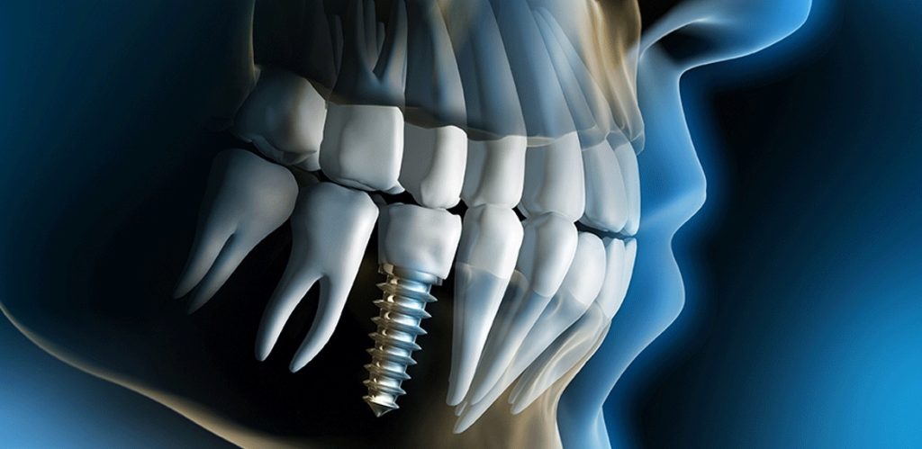 Dental Implant1s Dental Implant1s