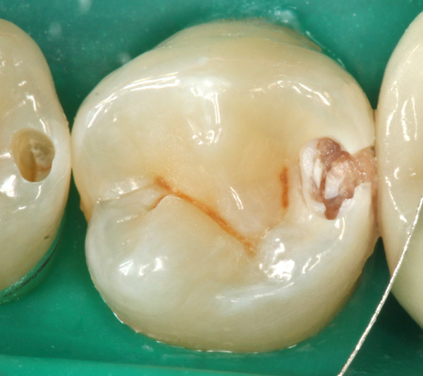 Karies 35 d aufgebohrt