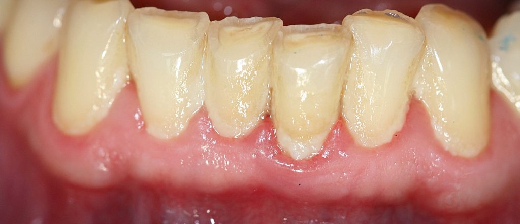 Plaque Gingivitis g 2 Plaque Gingivitis g 2