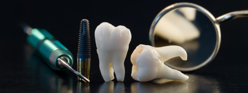 dental implants dental implants