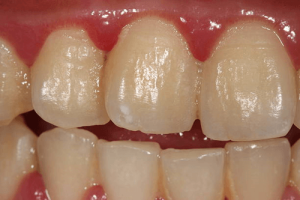 dental plaque