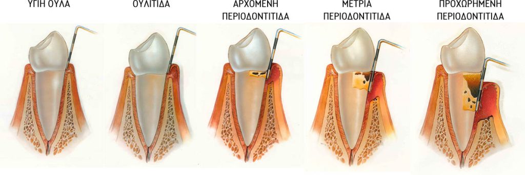 periodontitida oulutida periodontitida oulutida