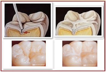 sealant sealant