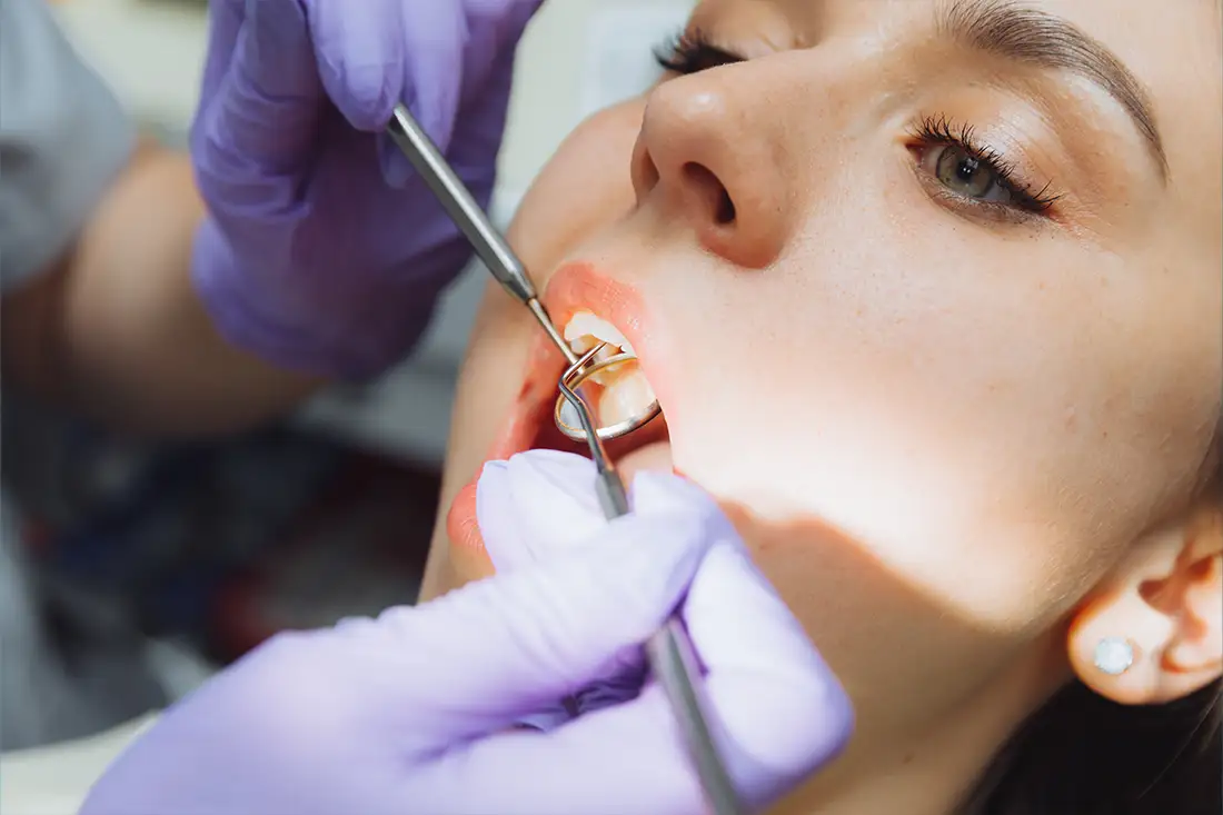 tooth filling
